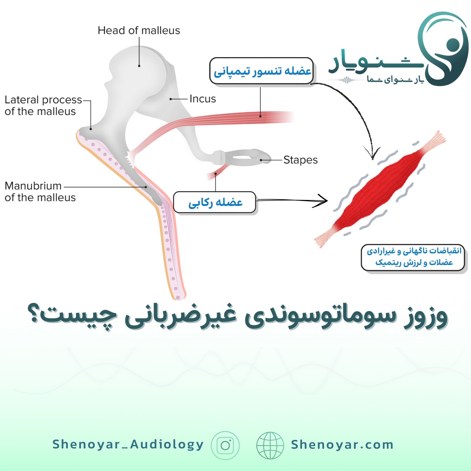وزوز سوماتوسوندی غیرضربانی چیست؟